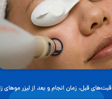 مراقبت های بعد از لیزر موهای زائد