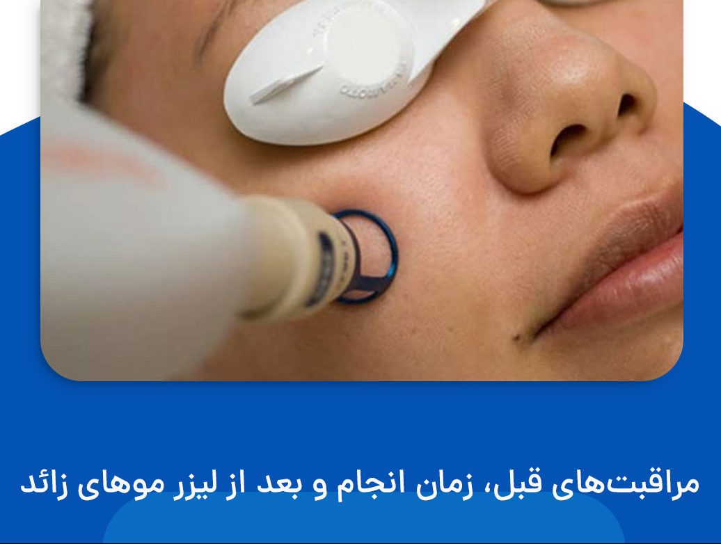 مراقبت های بعد از لیزر موهای زائد