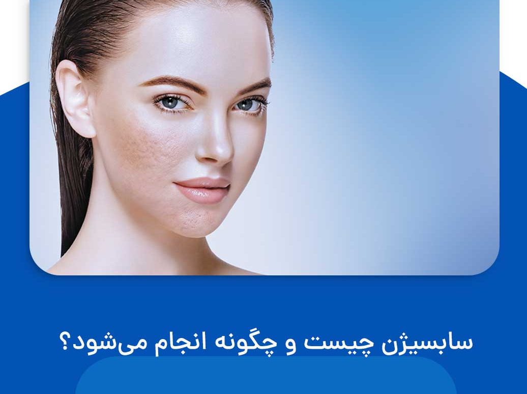 سابسیژن چیست